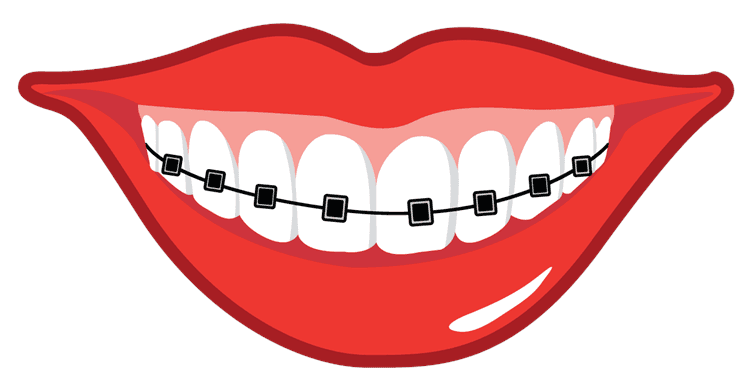 braces